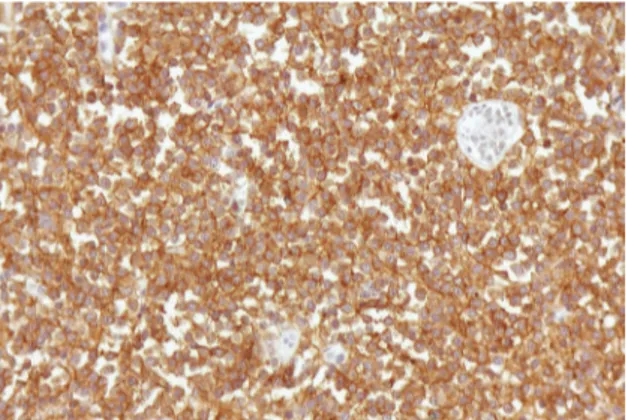 Figura  3  -  Coloração  imunohistoquímica  positiva  para  marcador  de  células  B  CD20  nas  células  de  linfoma  (×400).