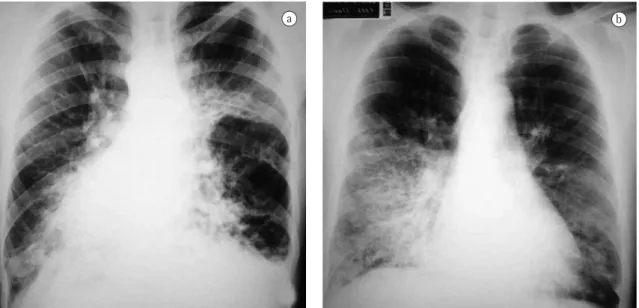 Figura 1 - Radiografia de tórax com imagens sugestivas de bronquiectasias. a) Presença de dextrocardia (Caso 3); e 