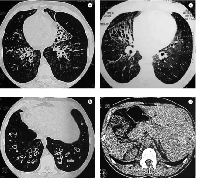 Figura 3 - Tomografia computadorizada de tórax evidenciando numerosas bronquiectasias císticas