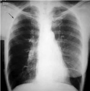 Figura  1  -  Radiografia  simples  de  tórax  em  posição 