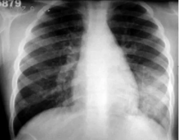 Figura  1  -  Radiografia  de  tórax  mostrando  infiltrado 