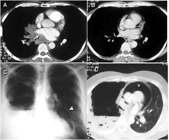 Figure 1 - A) Central mass invading the right inferior pulmonary vein and compressing the left atrium