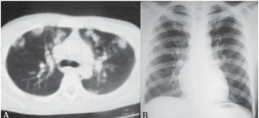 Figura 5 - A) Tomografia computadorizada de tórax no momento do diagnóstico;