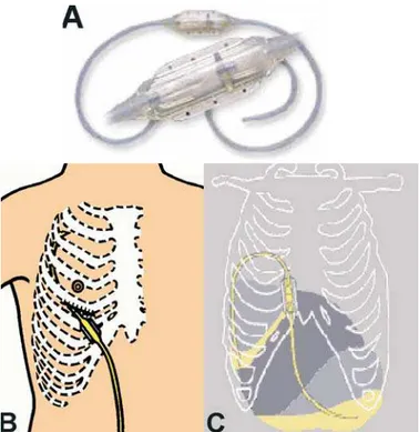 Figura 2 - “ Shunt  pleuro-peritoneal”; A) Cateter com recipiente (válvula unidirecional) interposto; B) Inserção de uma das extremidades na cavidade pleural e; C) Shunt em posição drenando líquido da cavidade pleural e direcionando-o para a cavidade abdom