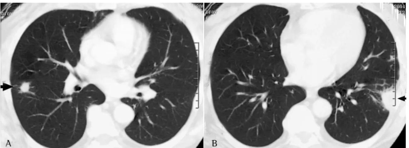 Figura 1 - A e B:  Tomografia computadorizada de tórax demonstrando nódulo pulmonar à direita e opacidade triangular