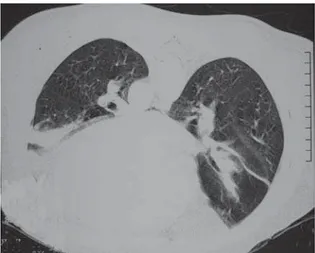 Figura 1 - Tomografia computadorizada de tórax em