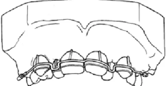 Figura 1: Aparelho Pin and Tube de Angle (Adapado de Rossouw, 2015) 