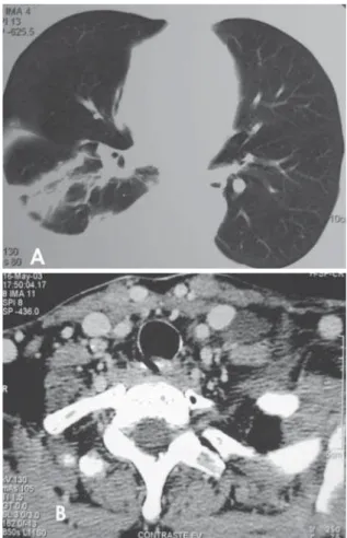Figura 1 - Radiografia de tórax mostrando derrame pleural