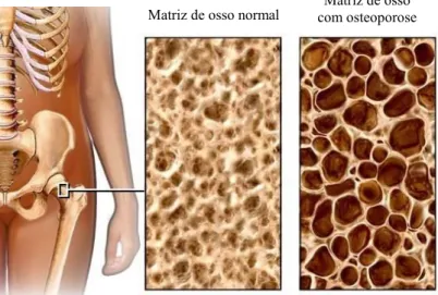 Figura 1.4 – Diferença entre a matriz óssea normal e a de um osso osteoporótico 18Matriz de osso normal Matriz de osso 