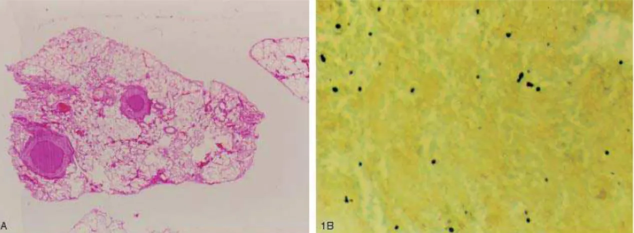 Figura 1 - A. Granuloma tuberculóide com necrose caseosa, coloração de hematoxilina-eosina(100 X)