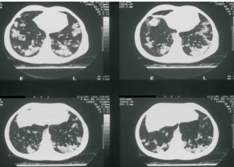 Figura 2 - infiltrado pulmonar difuso bilateral com zonas de granulosidade e algumas opacidades nodulares centrais .