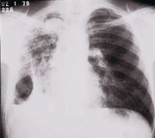 Figura 1.  Radiografia do tórax (Caso 10) com cavidade (4,5 x 3,5 x 2,5 cm) de parede espessa contendo produto patológico com densidade de partes moles (bola fúngica) no segmento apical do lobo superior do pulmão direito