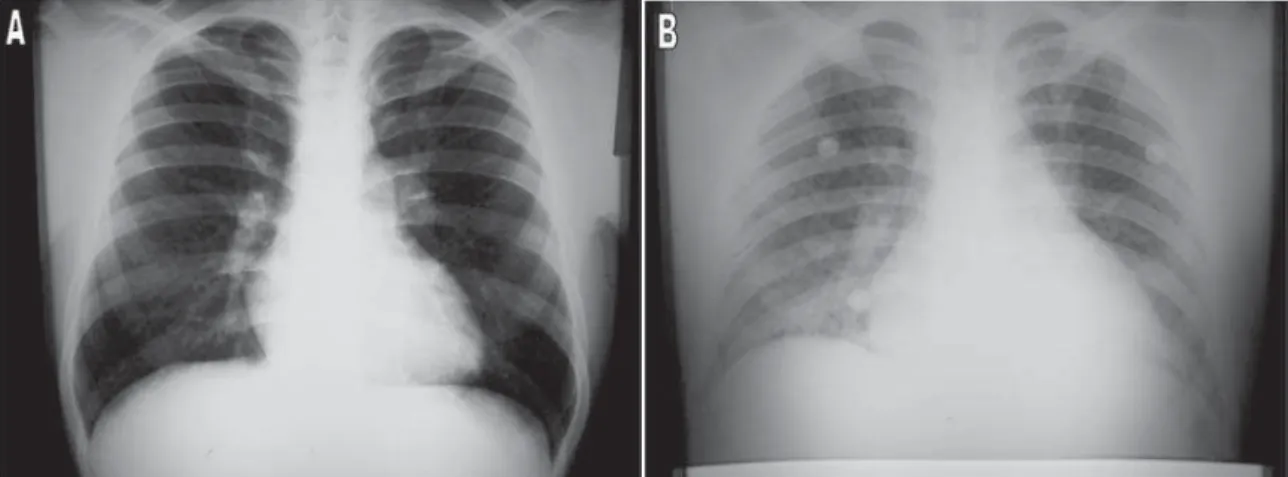 Figura 1 - A) Radiografia de tórax inicial aparentemente normal; B) Radiografia de tórax na admissão da UTI, com sinais