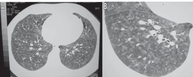 Figura 2 -  A e B) TCAR mostrando opacidades nodulares bilaterais  de limites imprecisos e vidro fosco difuso.