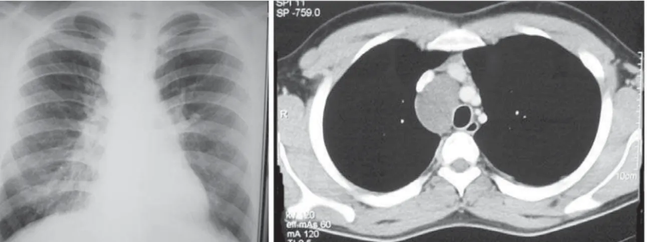Figura 1 - Telerradiografia de tórax póstero-anterior e tomografia computadorizada de tórax revelando lesão cística