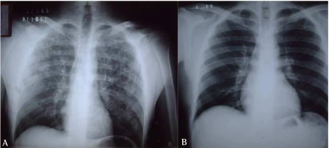 Figura 2 - Caso 2: A) Radiografia de tórax em póstero-anterior: infiltrado interstício-alveolar bilateral