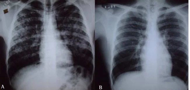 Figura 3 - Caso 3: A) Radiografia de tórax em póstero-anterior: infiltrado interstício-alveolar, bilateral, predominando