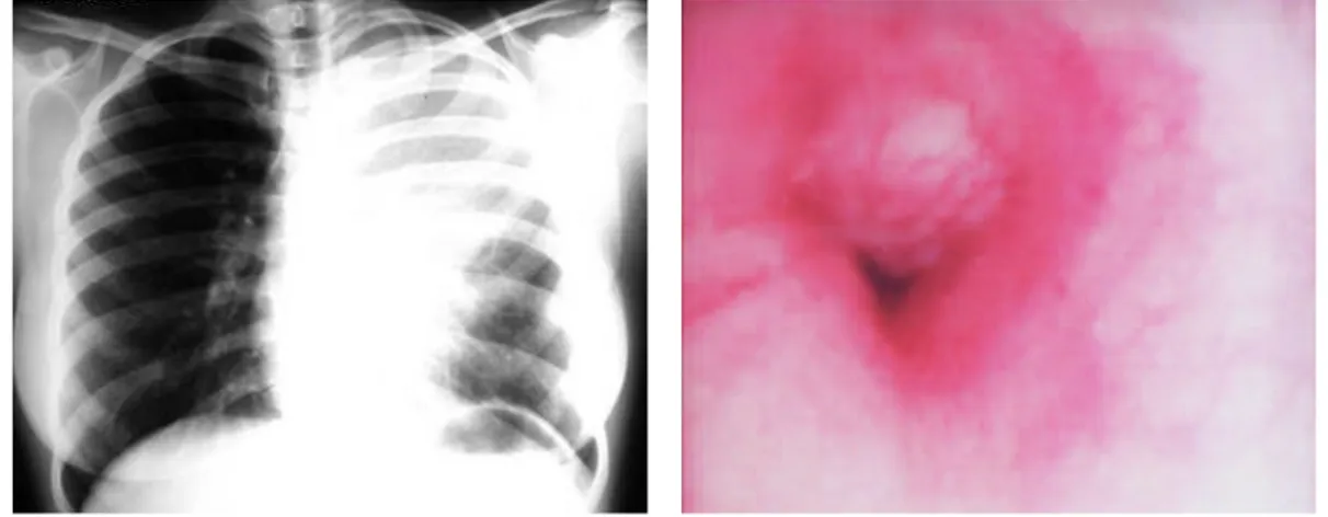 FIGURA 1: Radiografia do tórax com opacidade do lobo superior do pulmão esquerdo         