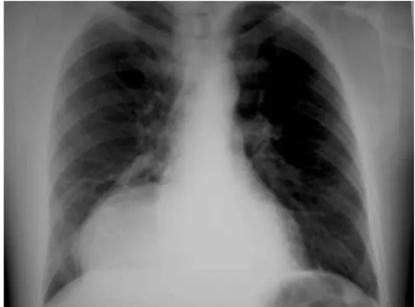 Figura 2 – Radiografia de tórax demonstrando aumento volumétrico da opacidade direita e alargamento do mediastino inferior (retrocardíaco)Lima(TE SBCT), Nuno Ferreira de, et al