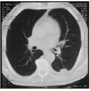 FIGURA 1: Derrame pleural 