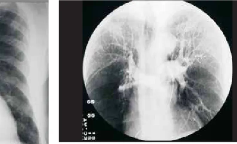 Figura 2 -  Angiotomografia computadorizada pulmonar. Dilatação do tronco  da artéria pulmonar