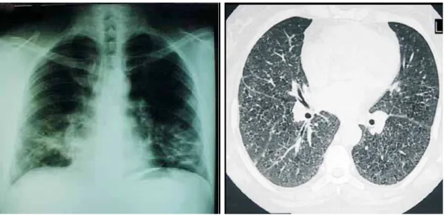 Fig ura  1 .   Radiogram a  sim ples  do  t órax  (à  esqu erda)  -   opacidades  em   faixa  n as  bases  pu lm on ares;  TCAR  (à  direit a)  -   vidro d esp o lid o ,  n ó d u lo s  cen t ro - lo b u la res  e  p eq u en o s  cist o s  d e  p a red es  