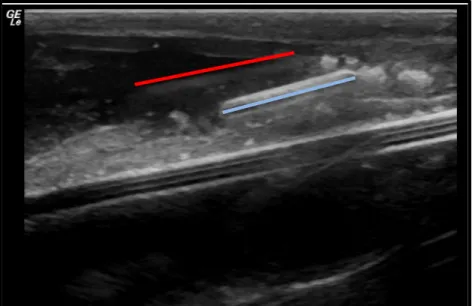 Figura  5  -  Imagem  de  ultrassonografia  após  aplicação  do  microchip  em  pepino  do  mar  não  anestesiado