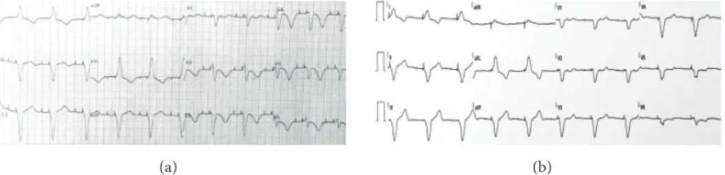 Figure 1: (a) Initial electrocardiogram showing an atrioventricular sequential paced rhythm with left bundle branch block morphology complexes, no ST-segment deviation, deeply inverted T waves on DI, aVL and precordial leads, and a prolonged QTc interval (