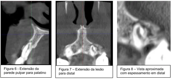 Figura 6 - Extensão da 