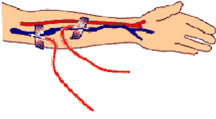 Figura 8. Representação da fístula em braço. 