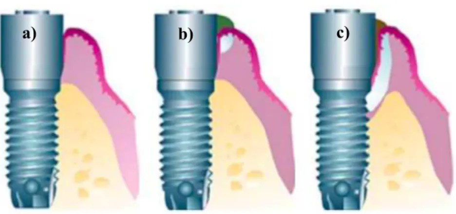 Figura  3:  Esquema:  a)  mucosa  peri-implantar  saudável;  b)  mucosite  peri-implantar; c)  peri-implantite