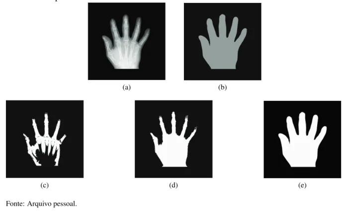 Figura 4 – 4a é imagem original; 4b é o ground truth; 4c, 4d e 4e são segmentações reali- reali-zadas com Coeficiente de Similaridade de Dice igual a 0, 6124, 0, 8528 e 0, 9895, respectivamente.