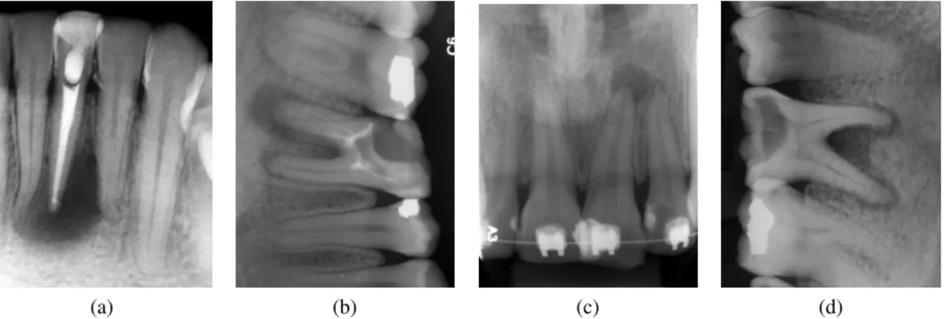 Figura 6 – 6a, 6b, 6c e 6d são exemplares de imagens de radiografias periapicais utilizadas neste estudo.