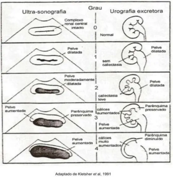 Figura  1-  Desenho  esquemático  hidronefrose  segundo  The  Society  of  Fetal  Urology  (SFU) 