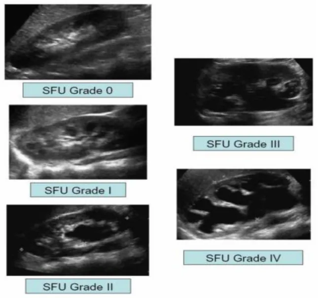 Figura 2  - Classificação  da hidronefrose de acordo com  The  Society  of  Fetal  Urology  (SFU) 