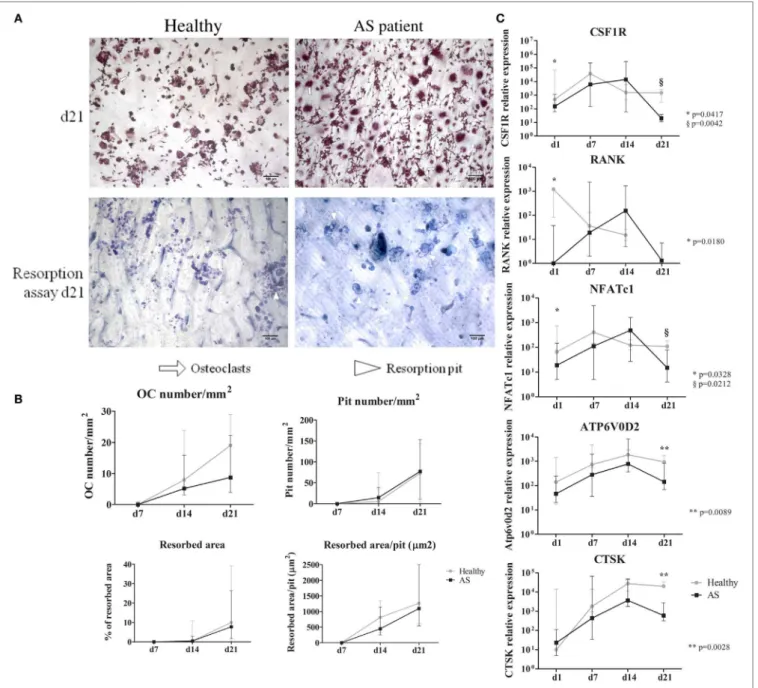 FigUre 3 | Functional assays and osteoclast gene expression. (a) Representative images of TRAP staining and resorption pits at culture day 21 are shown  for healthy and AS patients
