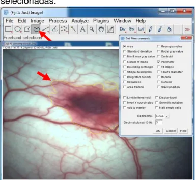 Figura  11  –   Área  tumoral  contornada  com  a  ferramenta  Freehand  selections  e  medidas  selecionadas
