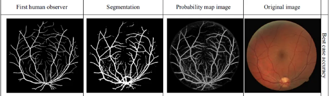 Figure 3.4: Best accuracy results obtained by Wang et al. [44] on DRIVE image.