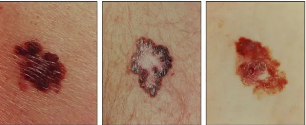 Figure 1.4: Examples of melanomas with characteristic asymmetry, border irregularity, color vari- vari-ation, and large diameter