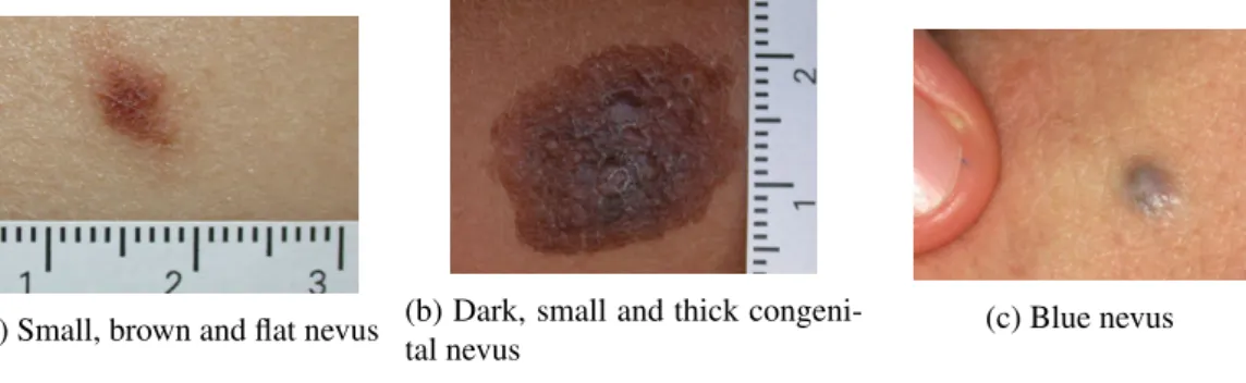 Figure 1.5: Photos of three different appearances of melanocytic nevi. Obtained from [19].