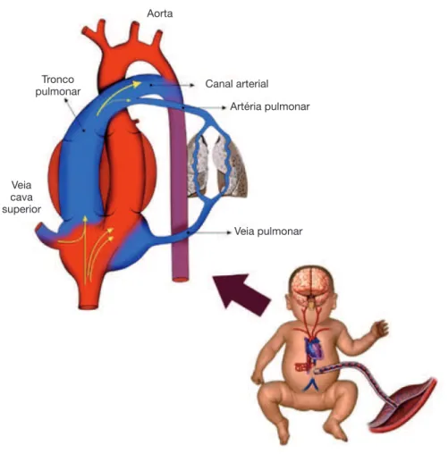 Figura 3   Resistência vascular pulmonar durante a transição da vida fetal a pós-natal.