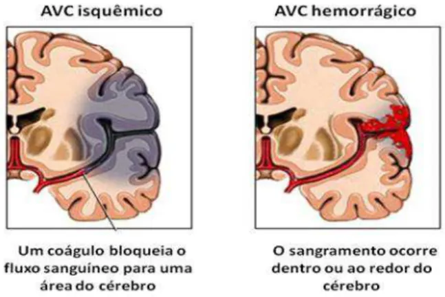 Figura 1  – Diferença na fisiopatologia do AVCI e AVCH. 