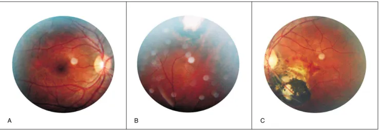 Figura 1 -  Fotografias coloridas de fundo do olho da mãe 14 meses após dar à luz o bebê com toxoplasmose congênita; a paciente havia 