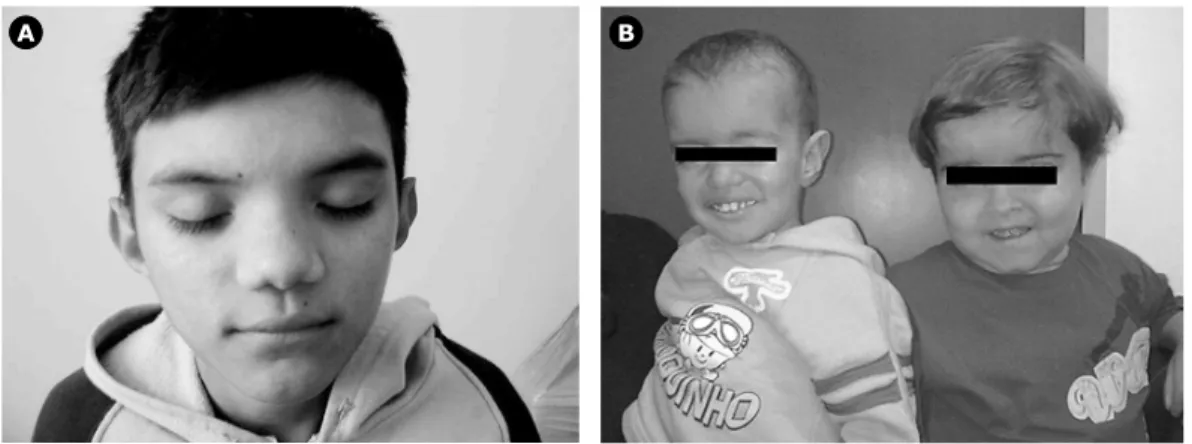 Figura 2 -  A) Fácies característico (nariz em sela) e rash urticariforme de paciente com doença inflamatória  multissistêmica de início neonatal; B) Fácies característico (embossamento frontal) de dois pacientes  com doença inflamatória multissistêmica de