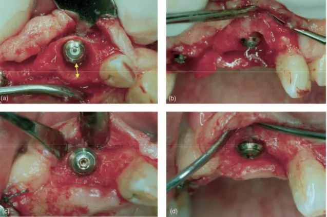 Figura 1. O implante foi instalado no alvéolo após extração dente 21(a) vista oclusal, (b) vista vestibular)