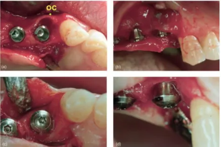Figura  4.  O  implante  foi  instalado  mais  palatinizado  após  extração  dente  14  (a)  vista  oclusal
