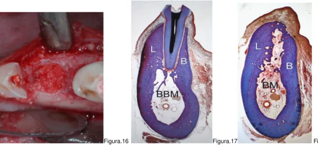 Figura 16. Fotografia ilustra a distal de um terceiro pré-molar inferior enxertado com colágeno Bioss®