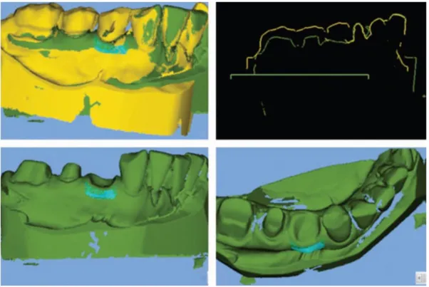 Figura  22.  Área  medida  de  mudanças  de  volume  dos  tecidos.  (a)  e  (b)  sobrepõem  imagens  que  demonstram  variações  volumétricas entre basal (área cor amarela) e após quatro meses (área cor verde)