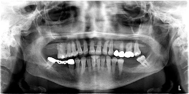 Fig. 22- Ortopantomografia 
