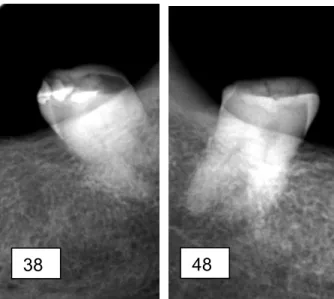Figura 13 - Radiografia dos dentes pilares  38 e 48 